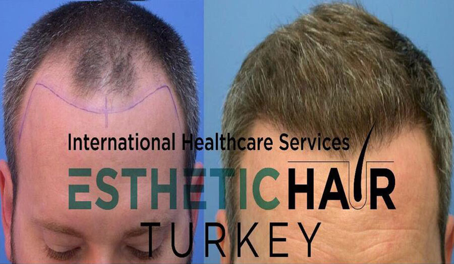 Having a hair transplant in Turkey or in the USA? (sponsored)